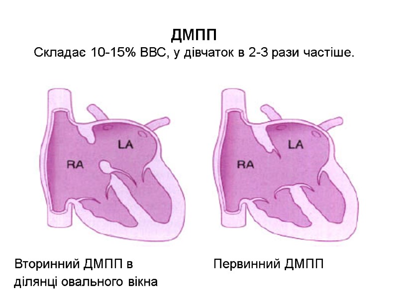 ДМПП Складає 10-15% ВВС, у дівчаток в 2-3 рази частіше. Вторинний ДМПП в 